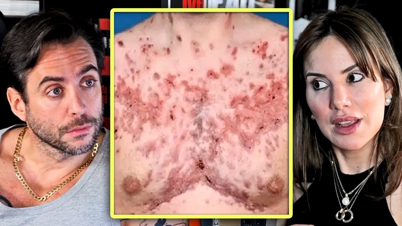 ME DA PÁNICO QUE LOS ESTEROIDES SE NORMALICEN- Endocrinóloga advierte de sus peligros